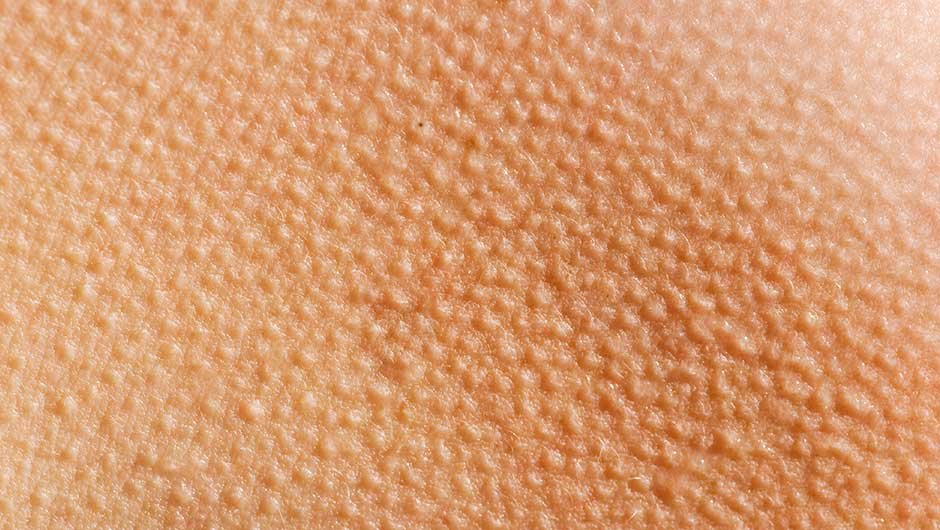 What is Keratosis Pilaris?